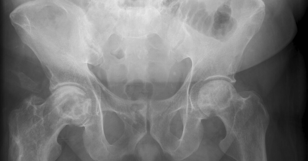 groin-pain-in-a-sickle-cell-disease-patient